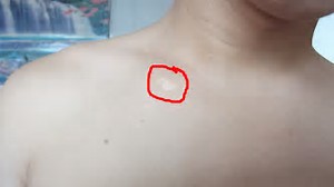 郑州哪家治疗白癜风的专科比较好